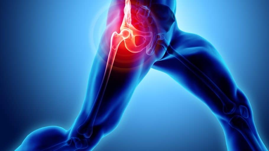 Durerea de sold: cauze, afectiuni, simptome si tratament Unguent pentru dureri de spate și șold