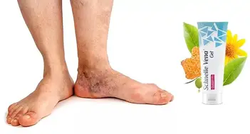 geluri de crema de la picioarele varicoase
