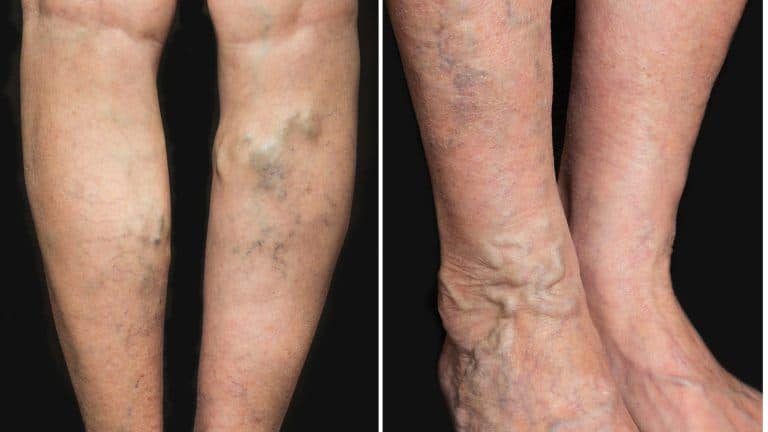 Cremă pentru picioare curate de varice - Complicații August - Crema de la vena varicoza pe picioare