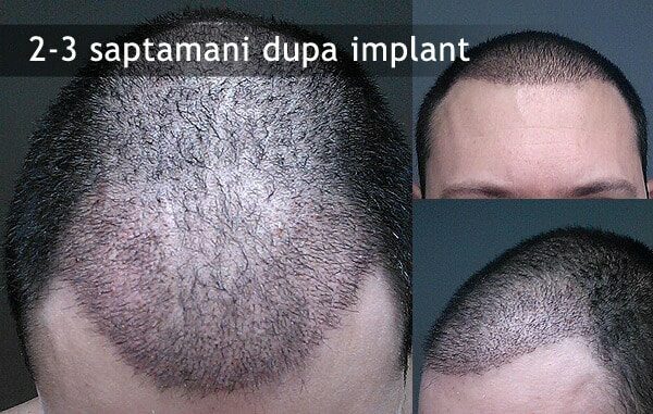 implant-de-par-1-3524913